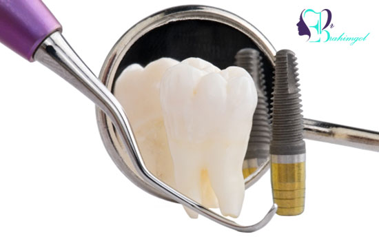 روش های افزایش دوام و مراقبت از ایمپلنت دندان چگونه است؟