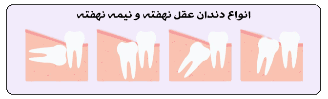 کشیدن دندان عقل - انواع دندان عقل