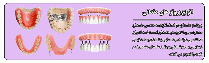 انواع دندان مصنوعی کامل بر پایه ایمپلنت  - پروتزهای دندانی